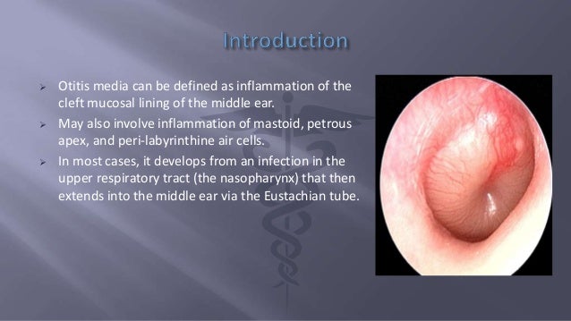 Catarrhal otitis: symptoms, diagnosis and treatment Catarrhal otitis: symptoms, diagnosis and treatment